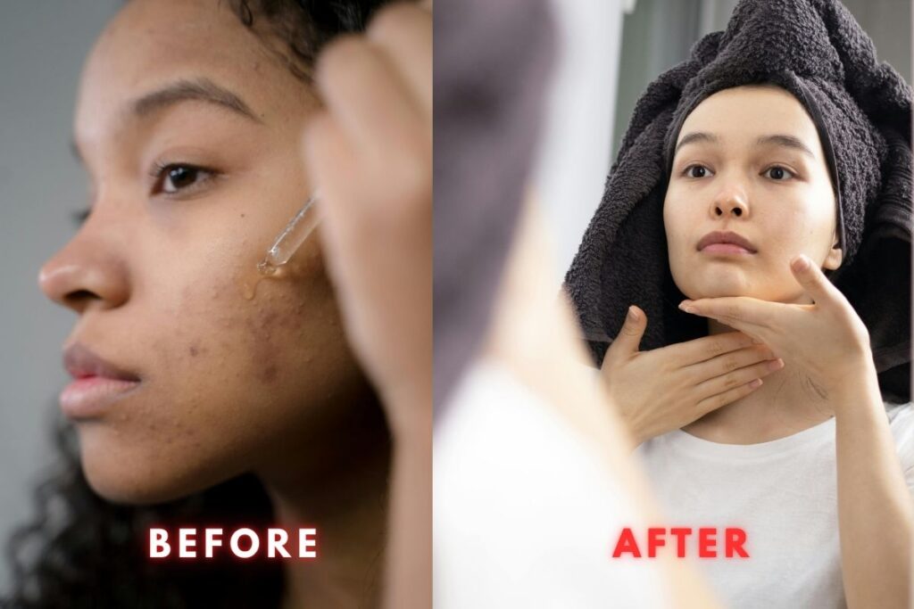 How to Get Rid of Skin Texture Fast & the Right Way